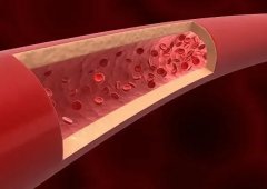 血管堵塞的检查方法和治疗途径