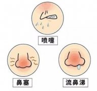 鼻炎怎么治疗彻底除根效果最好