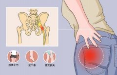 坐骨神经疼痛的症状,坐骨神经疼痛如何解决